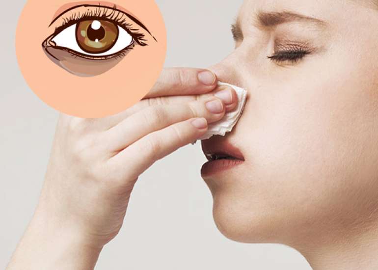 My daughter suffers from nasal allergies and has dark circles under both her eyes. Why does she have them?