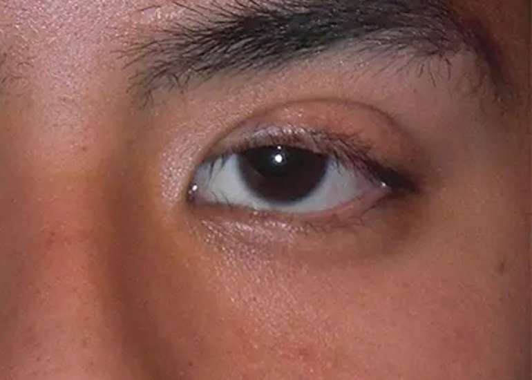 मायस्थेनिया ग्रेविस क्या है? कारण, लक्षण और इलाज | Myasthenia Gravis in Hindi