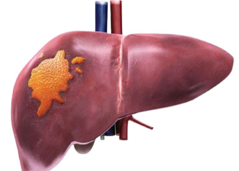 NAFLD and NASH in Risk Group's