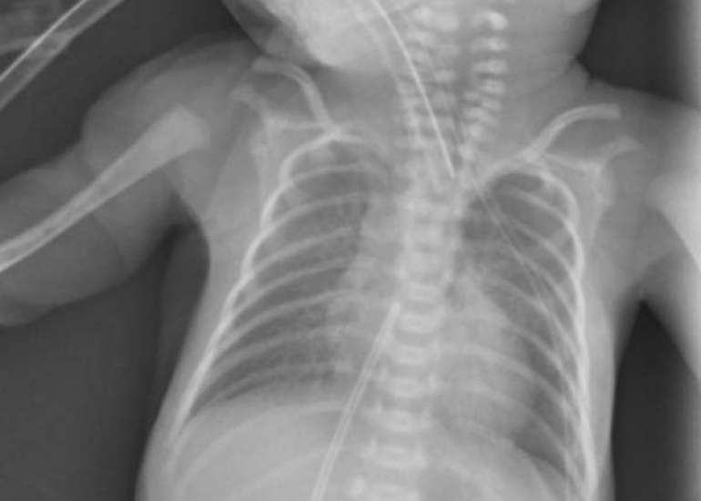 Nasogastric or Orogastric Feeding in Stable Preterm (≤32 Weeks) Neonates, which one should you prefer?