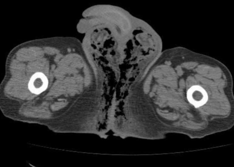Necrotic Vaginal Pressure Ulcer Repaired Using Vulvar Flaps