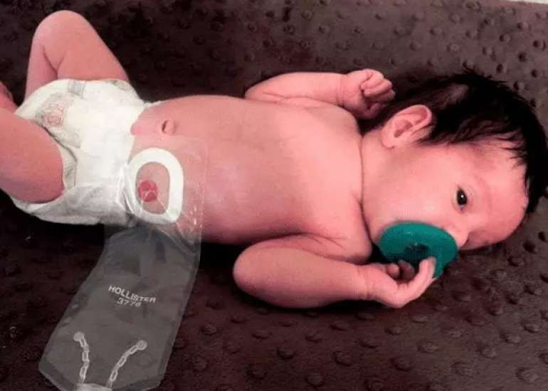 Neonatal Anorectal Malformations: A Case Study