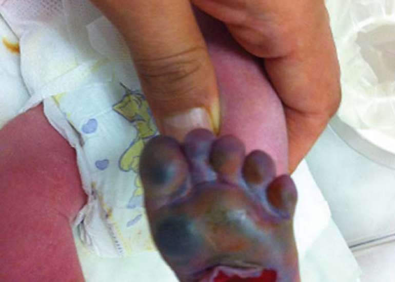 Neonatal Pain Response to Various Heel Prick Devices