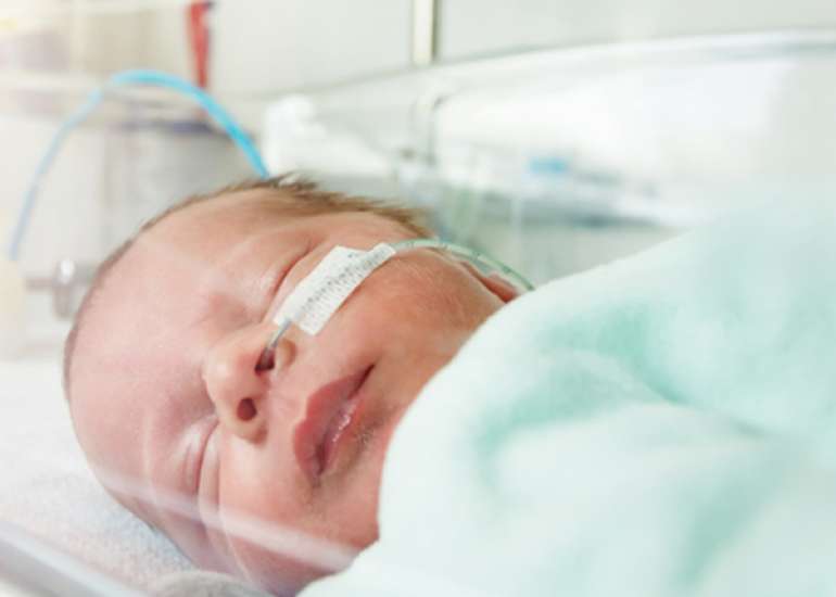 Neonatal stroke in premature neonates