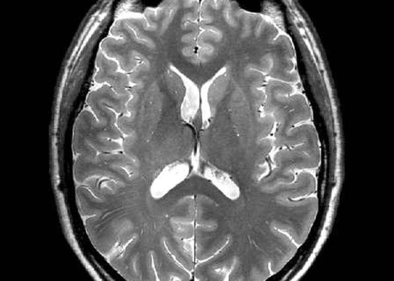 Neuroimaging Features in Eclamptic Encephalopathy