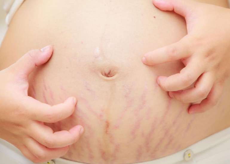 Neuroimmune modifications in atopic dermatitis during pregnancy