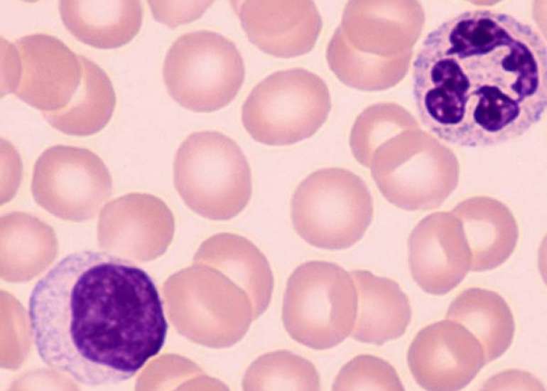 Neutrophil-to-Lymphocyte Ratio Correlates to the Length of Hospital Stay in Acute Appendicitis