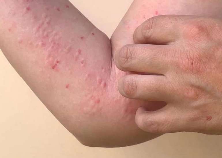 Tomato Fever Outbreak In India : Know The Symptoms