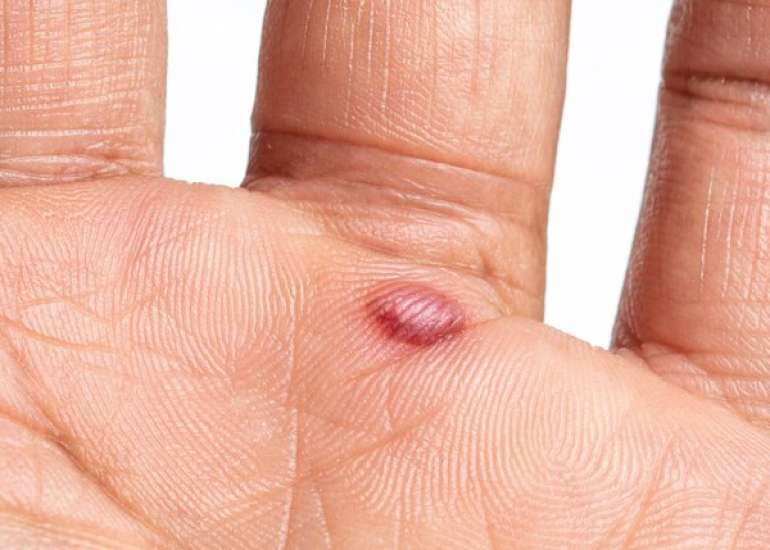ब्लड ब्लिस्टर क्या होता है? कारण, लक्षण और इलाज | Blood Blister in Hindi