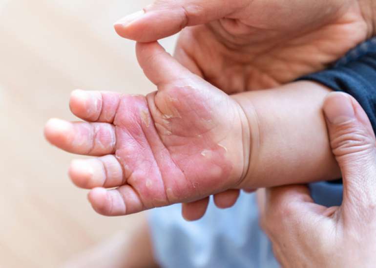 Non-pharmacological interventions lower the pain intensity of Children with Burns.