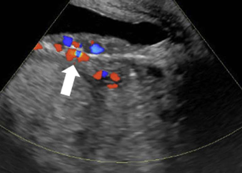 Obstetric and Maternal Outcomes after Before Uterine Artery Embolization