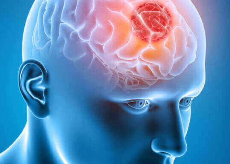 ऑलिगोडेंड्रोग्लियोमा क्या है? कारण, लक्षण और इलाज | Oligodendroglioma in Hindi