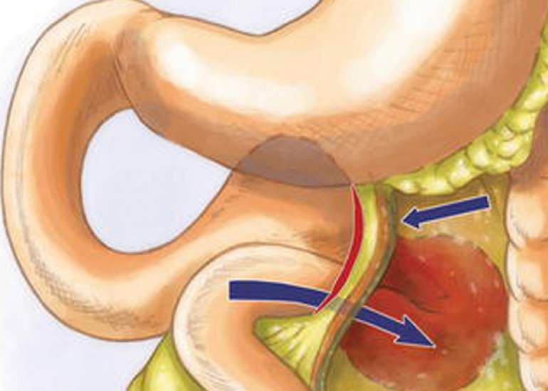 Omental Herniation: A Complication of Drain Site - A Case Report