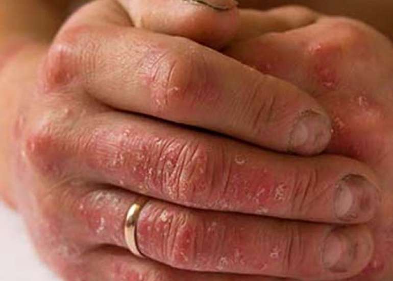 Ondansetron's Role in Managing Chronic Cholestasis-Related Pruritus