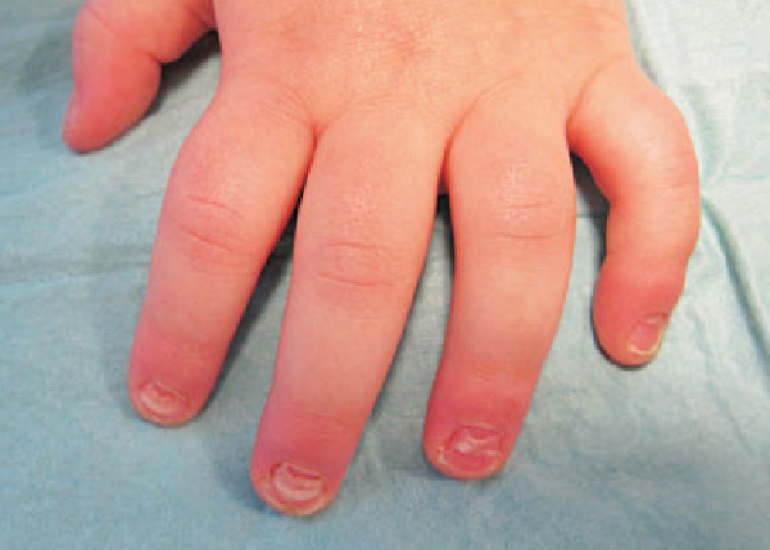 Onychomadesis secondary to hand-foot-mouth disease