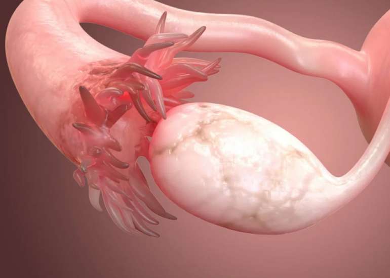 ऑओफोरेक्टॉमी क्या है? | Oophorectomy in Hindi