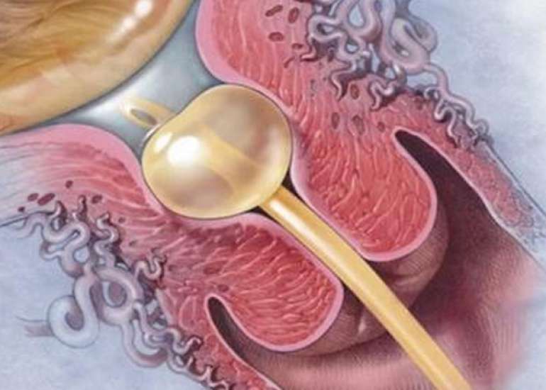 Oral Mifepristone Vs. Intracervical Foley’s Catheterization for Induction of Labor