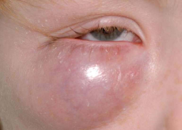 ऑर्बिटल सेल्युलाइटिस क्या है? कारण, लक्षण और इलाज | Orbital Cellulitis in Hindi