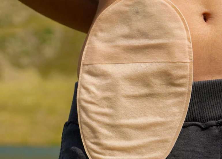 Ostomy Surgery: All You Need To Know