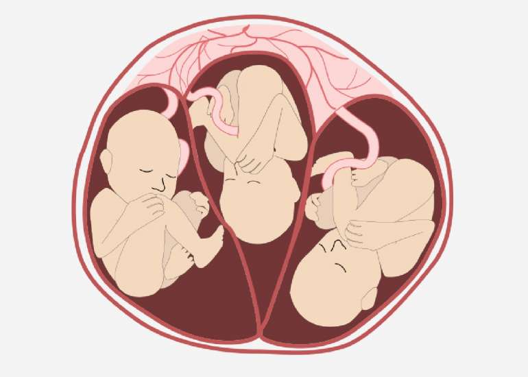 Outcomes in intervention and management of multiple pregnancies trials: A systematic review