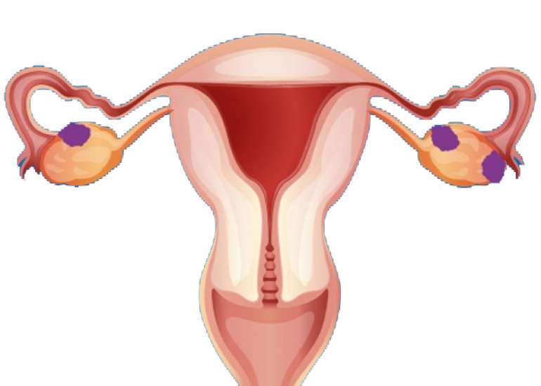Ovarian adenocarcinoma in a 14-year-old girl