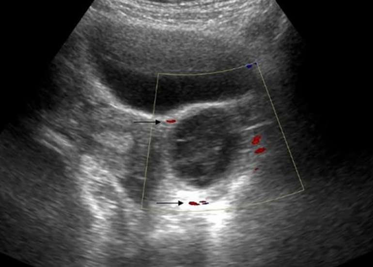 Ovarian Torsion Premenarch