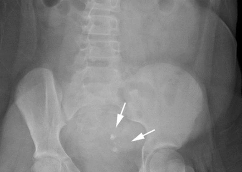 Ovarian Torsion in a Young Adolescent with Rokitansky Syndrome