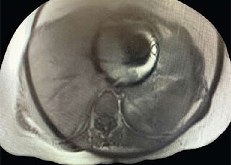 Painful Abdominal Wall Mass Requiring Resection in the Second Trimester