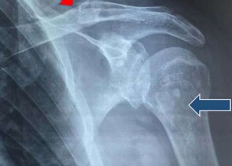 A Giant Parathyroid Adenoma in an Adolescent Male