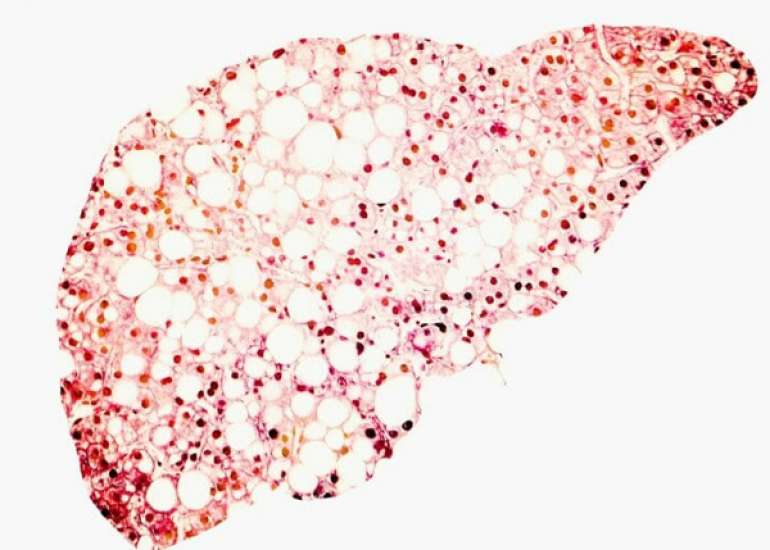 Pathogenesis of Metabolic Liver Disease