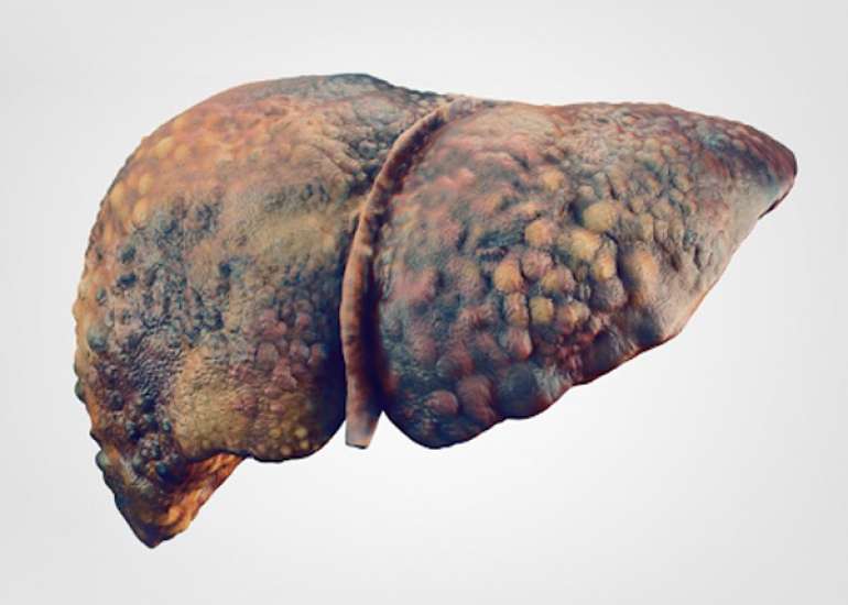 Pathophysiology of Alcoholic Liver Diseases