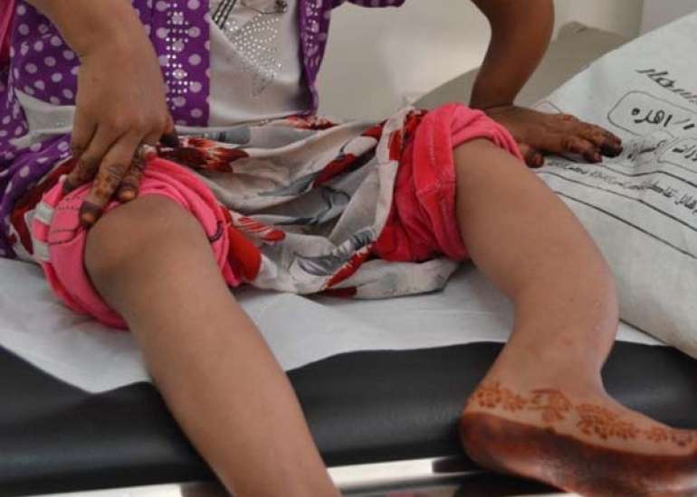 Pediatric Renal Rickets 