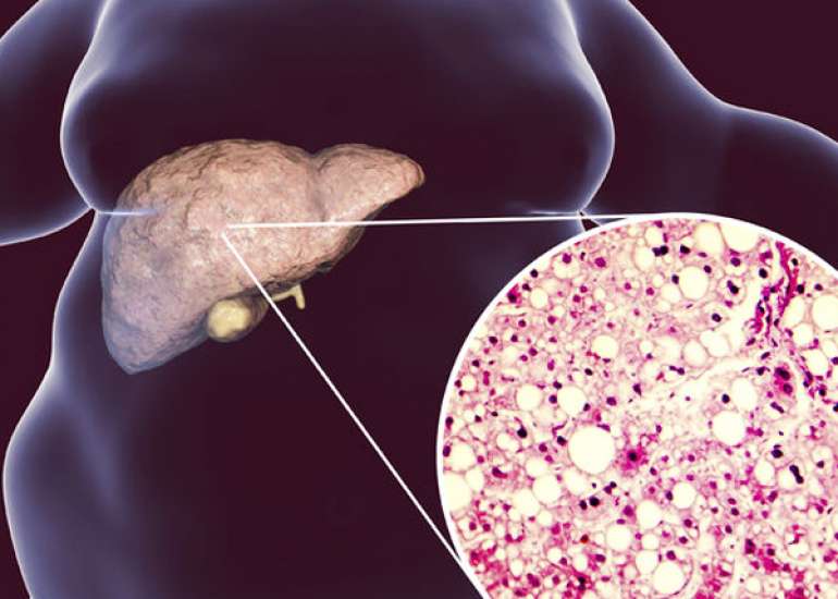 Pediatric Fatty Liver Disease