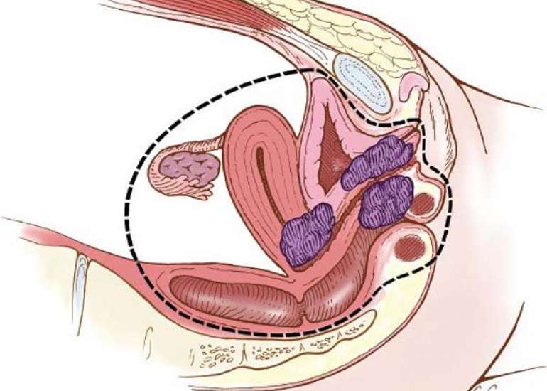 Pelvic Exenteration Study: Characteristics and Outcomes of Patients Undergoing Pelvic Exenteration for Recurrent Gynecological Malignancy