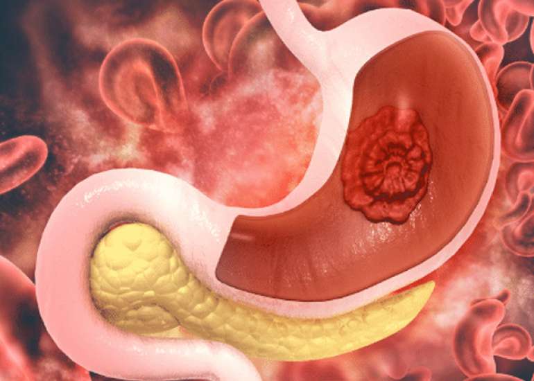 Peptic Ulcers: Causes, Symptoms and Treatment