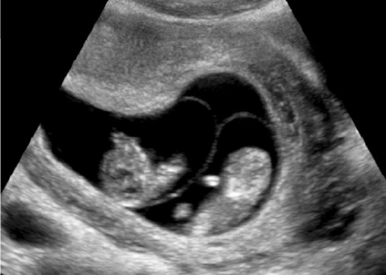 Perinatal Catatonia in Twin Pregnancy case of Unknown Chorionicity and Gestational Age