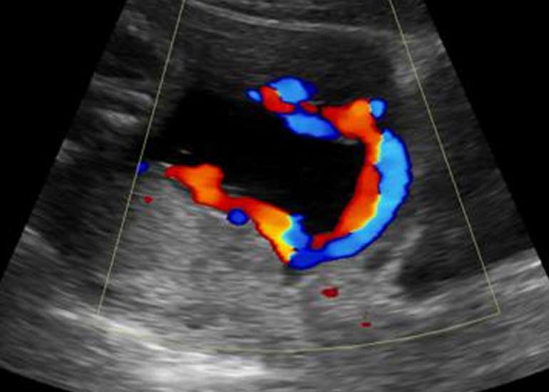 Persistent funic presentation due to velamentous cord insertion adjacent to the internal os