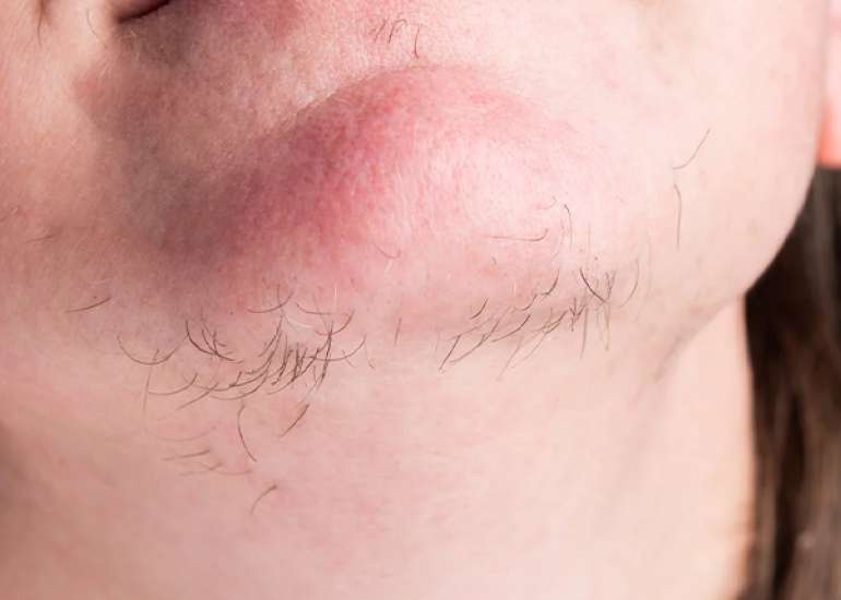 Pharmacotherapies for the treatment of hirsutism