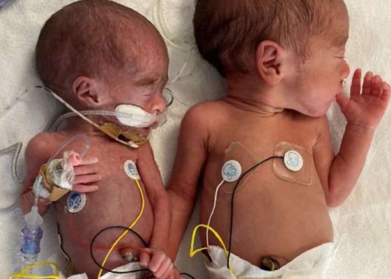 Physiological Stress During Minimally Invasive Surfactant Therapy (MIST) in Very Preterm Infants