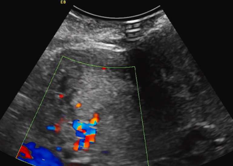 Placenta accreta in a mid-trimester post-abortal hemorrhage case