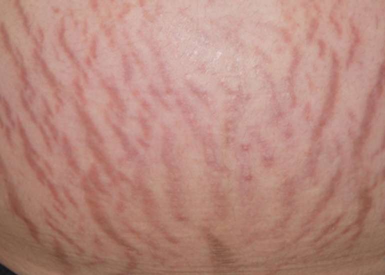 Platelet-rich plasma for striae distensae