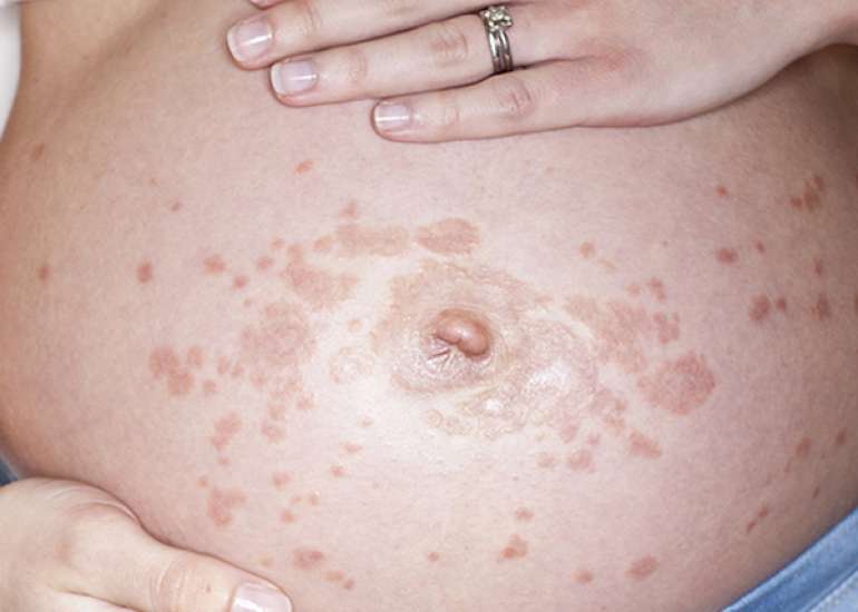 Polymorphic eruption of pregnancy