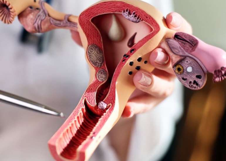 Postmenopausal Bleeding With a Diadelphic Uterus