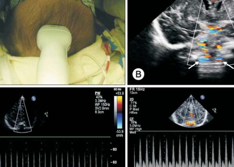 Predicting Fluid Responsiveness in Children with Shock
