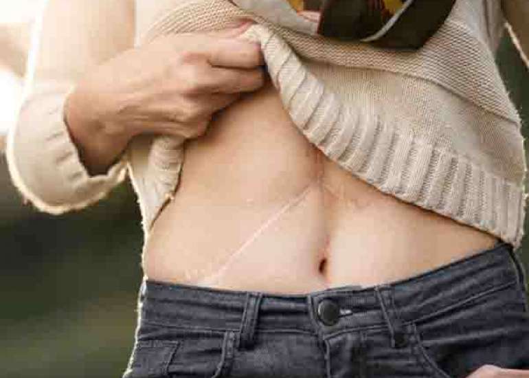 Pregnancies following liver transplantation