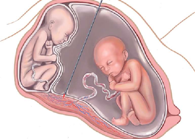 Pregnancy Outcomes of Previable and PROM following Laser Photocoagulation for Twin-Twin Transfusion Syndrome