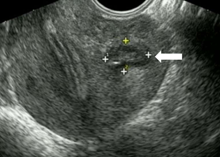 Pregnancy outcome after ultrasound-guided drainage and sclerosis of cystic adenomyoma