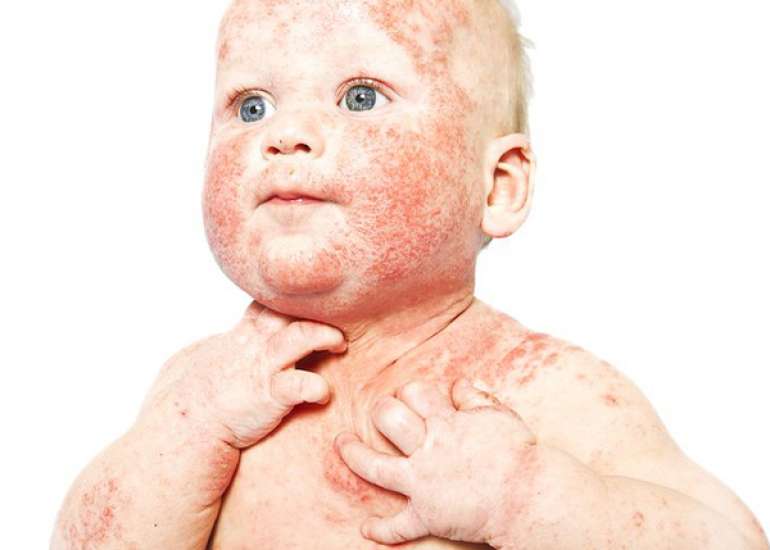 Intralesional Sclerotherapy Cures Unusual Presentation of Hemangioma in a Child