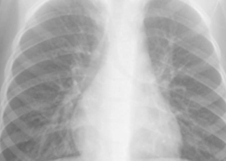 Procalcitonin as Point-of-Care Testing Modality for Diagnosing Pneumonia in Children With ILI