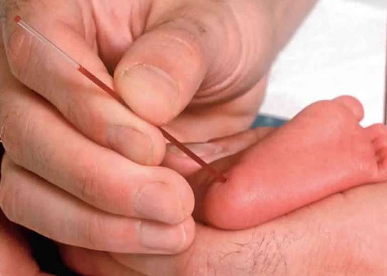 Procedural Pain Response to Various Heel Prick Devices in Neonates
